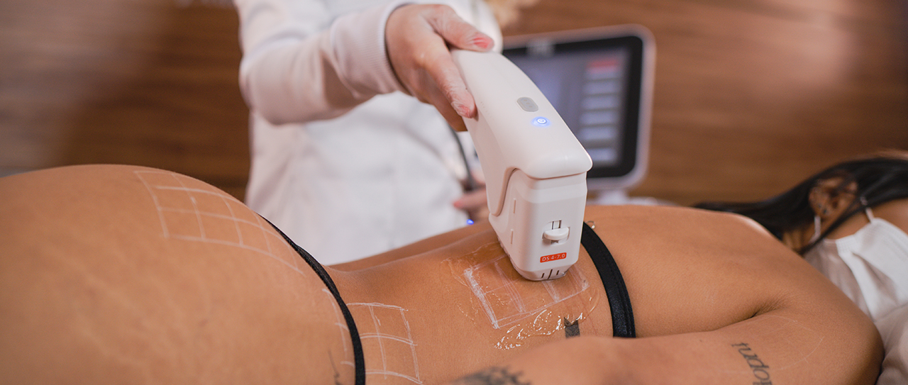 Herus HIFU 4D: como combinar micro e macrofocado para lifting e remodelação corporal avançada